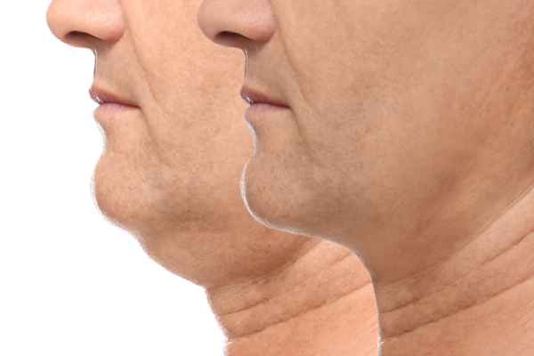 HIFU - Breakthrough in Anti - ageing 2 hifu results Melksham