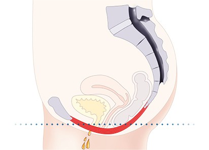 Pelvic-Floor Muscle Repair 5 Pelvic floor muscles Melksham