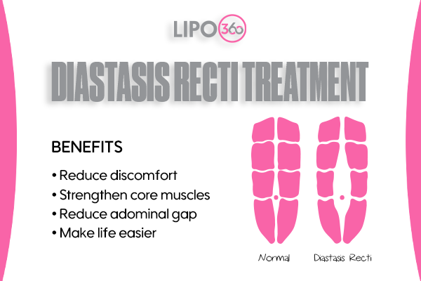 diastasis recti treatment Melksham