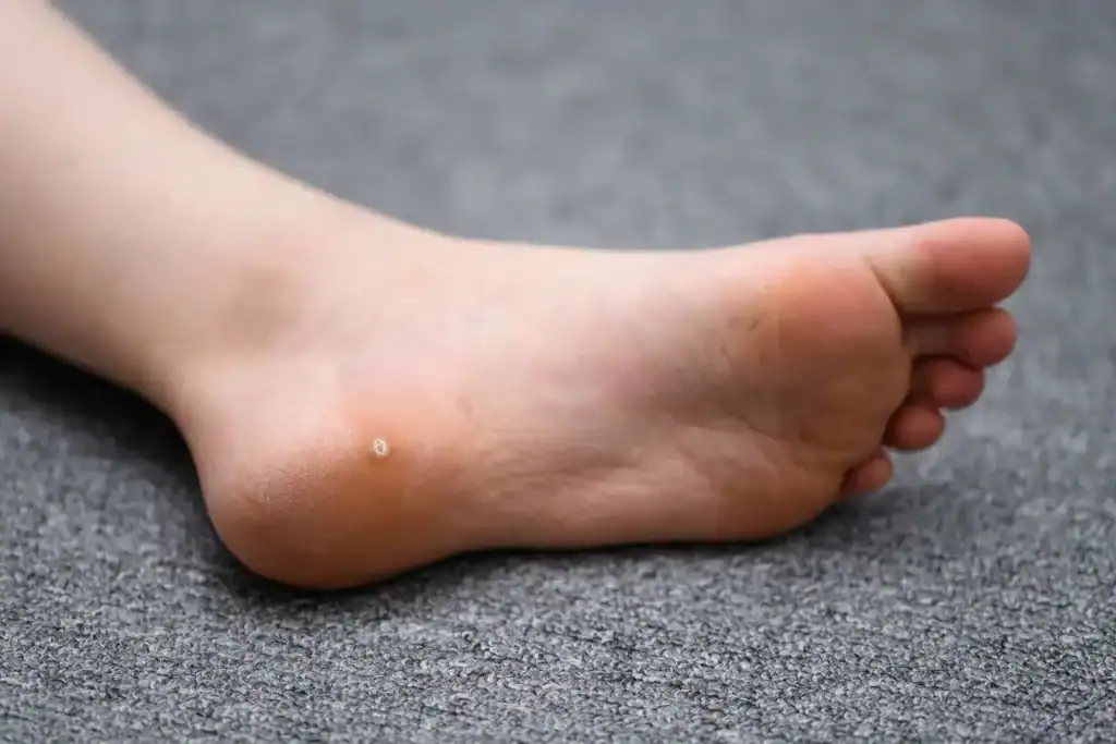 Cryotherapy For Warts And Also Verrucas 2 Image of verruca on the bottom of the foot that able to be treated with Cryotherapy Melksham