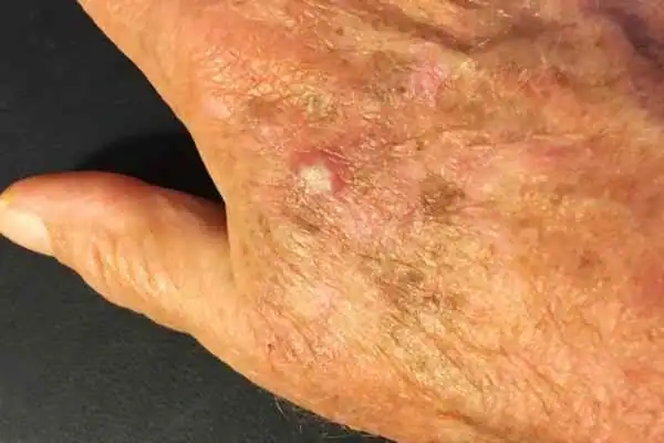 Image of Actinic keratoses Melksham on a person hand