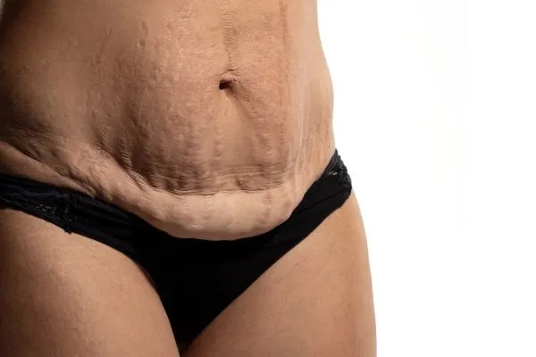 The science behind skin tightening Melksham picture of a woman's sagging skin on the stomach